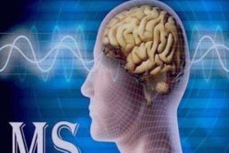روند پیشرفت بیماری ام.اس در جامعه با شیب بسیار تندی مواجه است روند پیشرفت بیماری ام.اس در جامعه با شیب بسیار تندی مواجه است
